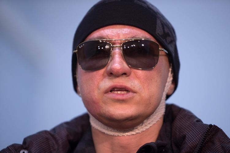 Angrebet. Sergej Filin (billedet) fik alvorlige forbrændinger i ansigtet ved angrebet 17. januar og er for tiden i behandling i Tyskland. 
