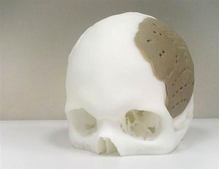 INNOVATION. Nu kan man 3D-printe knogleproteser til sin krop. En mand i USA har fået erstattet 75% af sit kranie med en 3D-printet kopi efter at være kommet til skade. (Foto: Oxford Performance Materials) 