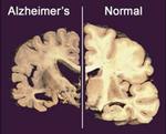 Alzheimers Research