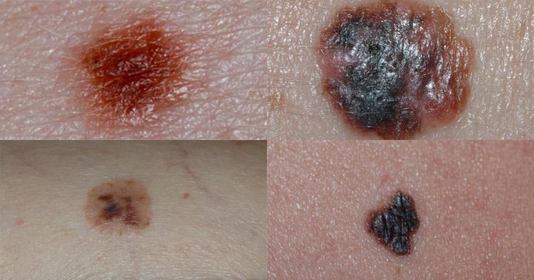 FARESIGNAL. Modermærket øverst til venstre er sundt - de tre andre kan være syge. Foto venligst udlånt fra www.skincancer.dk 