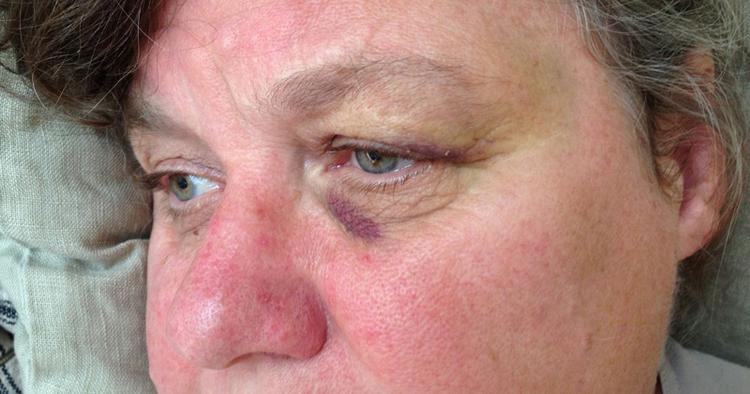 BØLGEBANK. Pylle Søndergaard blev grueligt forslået, da en kæmpebølge slyngede hende ind i en badebro ved Sjællands Odde. 