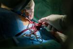 Indgreb. Det tager et par timer at få indopereret en pacemaker. Lægen laver et snit på ca. 5 cm oppe ved kravebenet, hvorfra pacemakerens to ledninger føres ned i hjertet. Til sidst placeres pacemakeren under huden. 