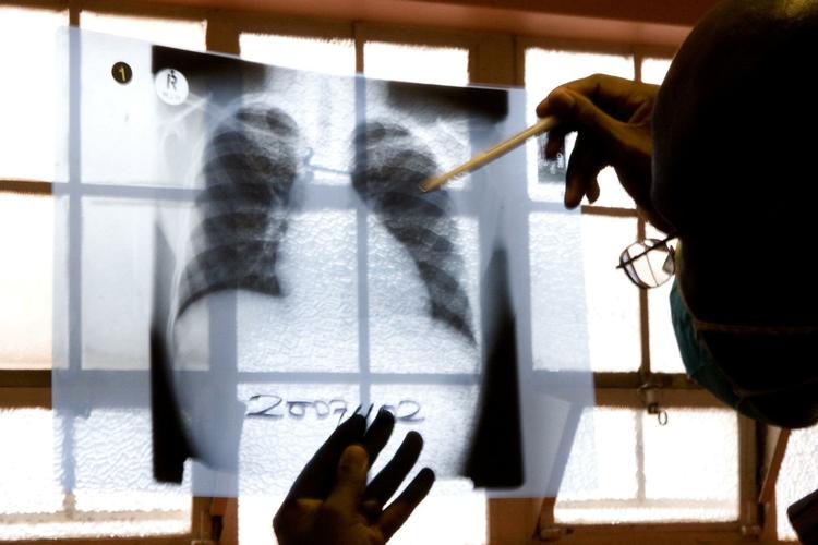 Smittefare. Dansk Serum Institut har tidligere kaldt antallet af tuberkulose-ramte i Danmark for bekymrende, og overlæge Sören Thybo kalder behandlingstiden for den ingusjetiske mand for »et kæmpe problem«. 