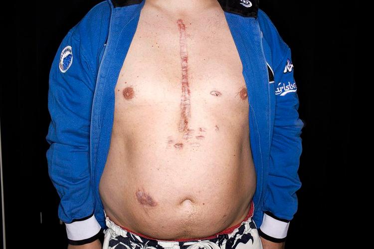 Slidt. Torben brugte steroider i fem måneder. Det var nok til at ødelægge hans hjerte. Først fik han et mekanisk hjerte og senere en transplantation. 