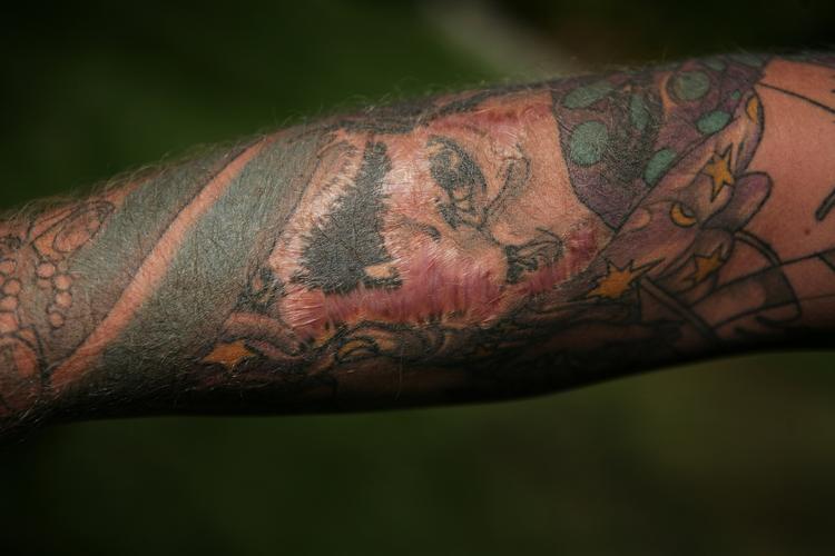 reaktioner. 52 procent af dem, der har en tatovering, ved ikke, at man kan få allergiske reaktioner af tatoveringer. Og mere end hver tiende har gener ved deres tatoveringer. 