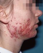 Akne. Unge mennesker bliver i højere grad behandlet med antibiotika mod akne. Eksperter advarer mod selv små doser, som kan gøre bakterier resistente. På billedet ses et alvorligt tilfælde. Antibiotika bliver også brugt til patienter med akne i mindre grad. 