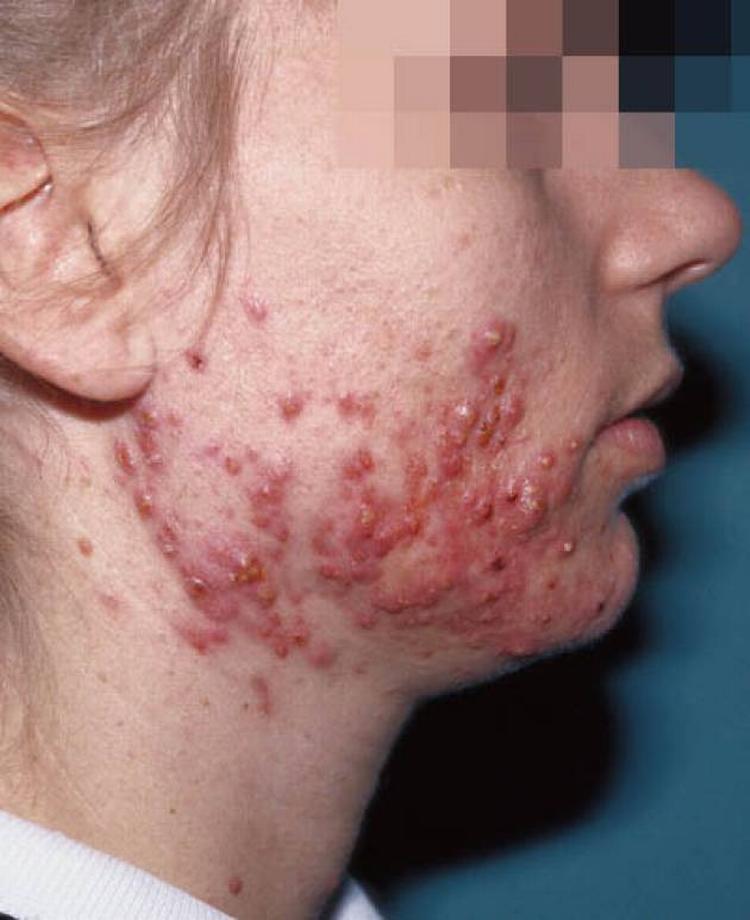 Akne. Unge mennesker bliver i højere grad behandlet med antibiotika mod akne. Eksperter advarer mod selv små doser, som kan gøre bakterier resistente. På billedet ses et alvorligt tilfælde. Antibiotika bliver også brugt til patienter med akne i mindre grad. 