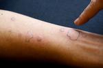 RB PLUS: Allergivaccination giver færre sygedage