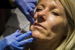 rynkefrit. Botox bliver brugt til behandling mod rynker. 