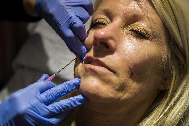 rynkefrit. Botox bliver brugt til behandling mod rynker. 