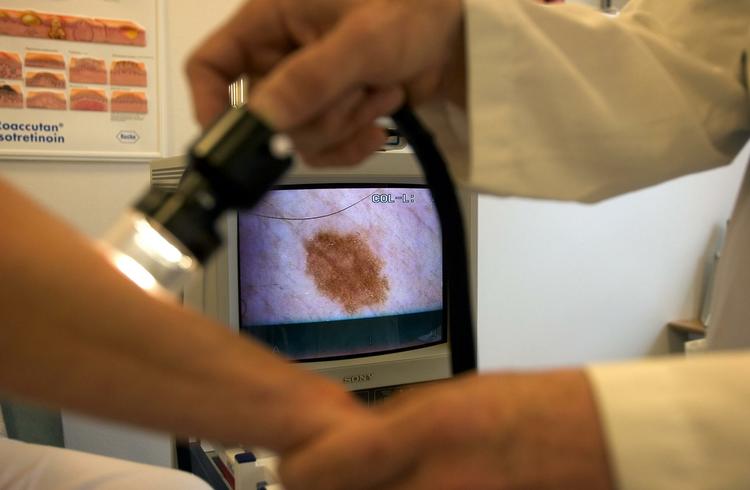 undersøgelse. I næste uge kan du komme ind fra gaden og få tjekket dine modermærker ved cirka 45 hudlæger landet over. 