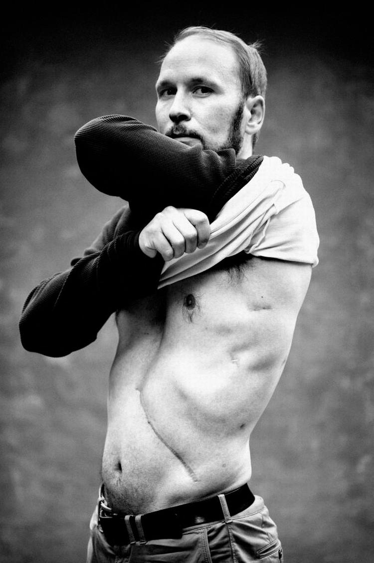 Ar. Her ses Anders Jørgensens ar fra kræftoperationen. Foto: Miriam Dalsgaard 