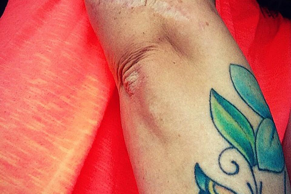 Kristine Lundsgaard, 32 år, diagnosticeret med modermærkekræft i 2008. 