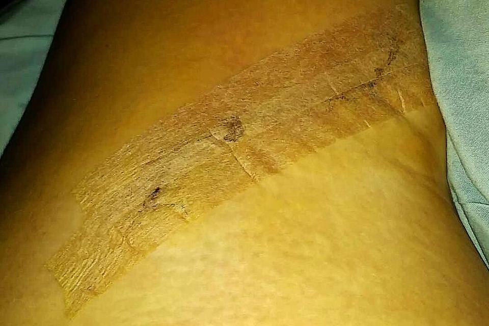 Michelle Juul Berthou, 23 år, diagnosticeret med modermærkekræft for tre uger siden. 