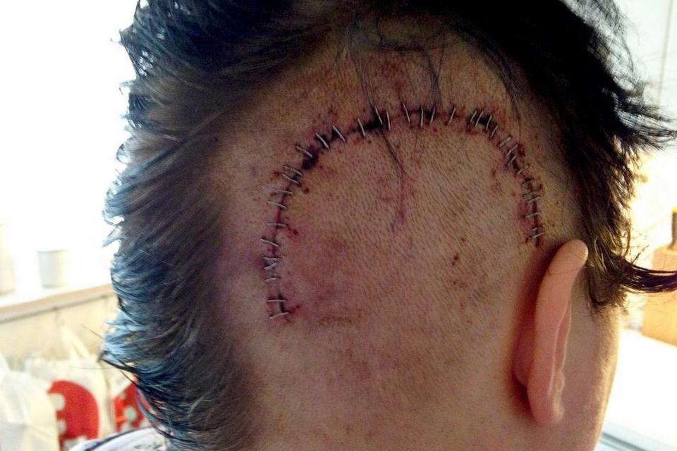 Anita Nordahl Neumann, 35 år, diagnosticeret med hjernekræft i 2013. 