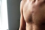 Nikolaj Aarestrup Hviid, 30 år, diagnosticeret med hodgkins lymfon (lymfekræft) i 2013 
