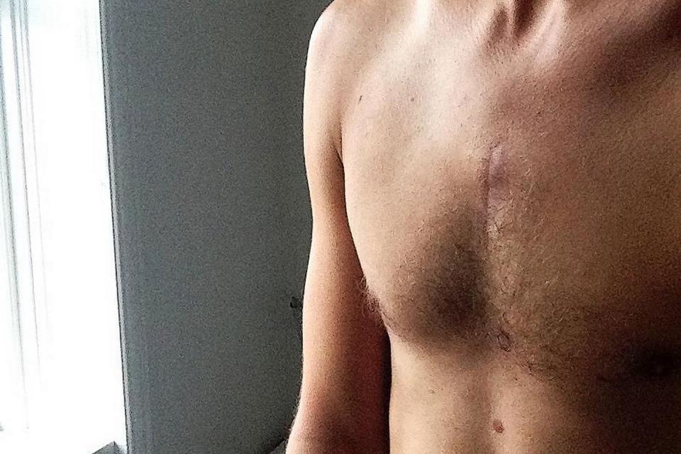 Nikolaj Aarestrup Hviid, 30 år, diagnosticeret med hodgkins lymfon (lymfekræft) i 2013 