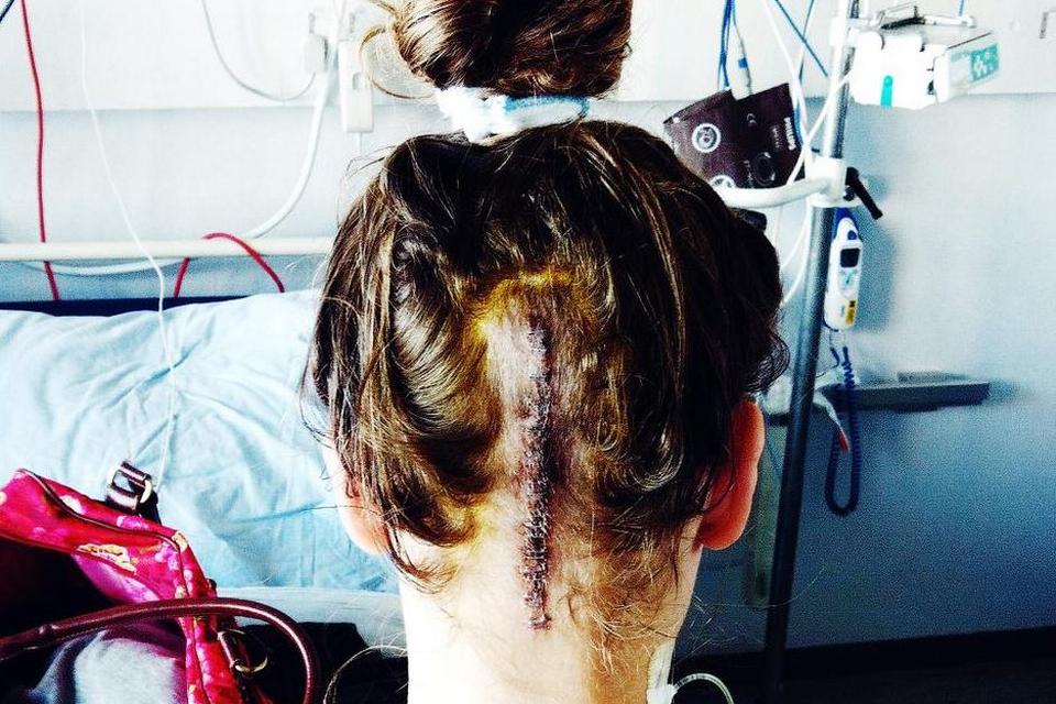 Josephine Blossfeldt, 17 år, fik en cyste i hjernen i 2014. 