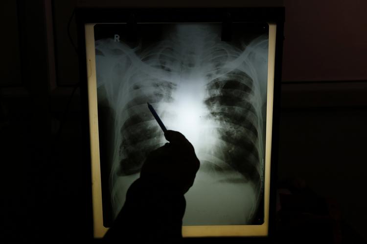 UNDERSØGELSE. Indisk læge ser på et røntgenfoto af lungerne på en patient, der skal kontrolleres for tuberkulose. 