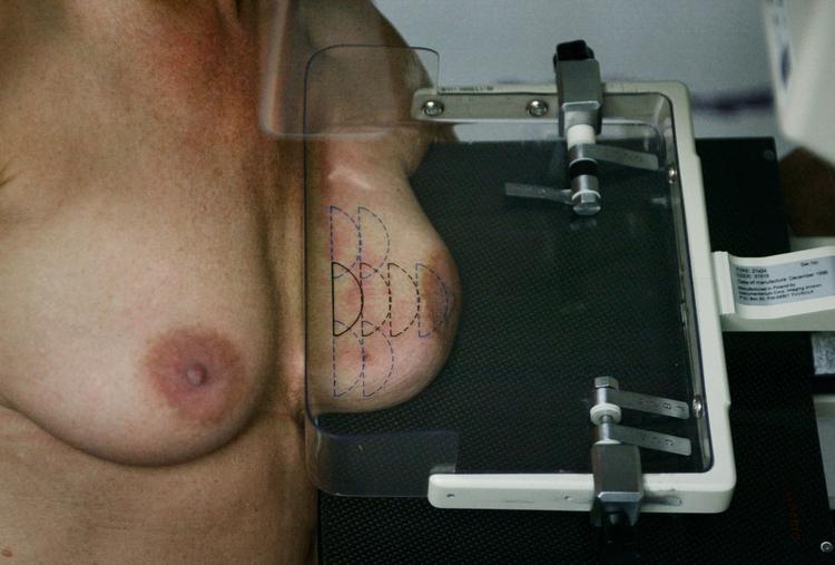 forsinket. Kvinder, der er blevet indkaldt for sent til brystkræftscreening, er efter alt at dømme ikke berettiget til erstatning, selv om kræften kunne være opdaget tidligere. 