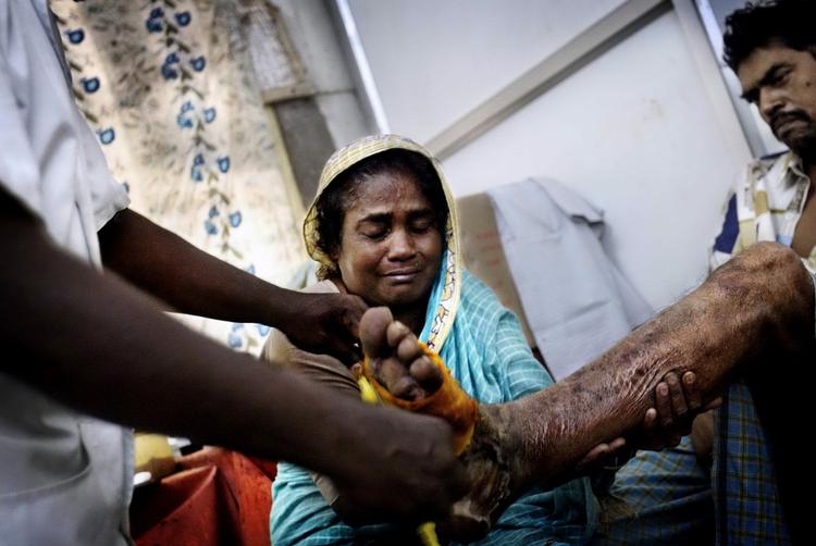 DIABETES. Hvert år mister 40.000 indere en fod på grund af diabetes. Konsekvensen er ekstrem fattigdom og tidlig død. 