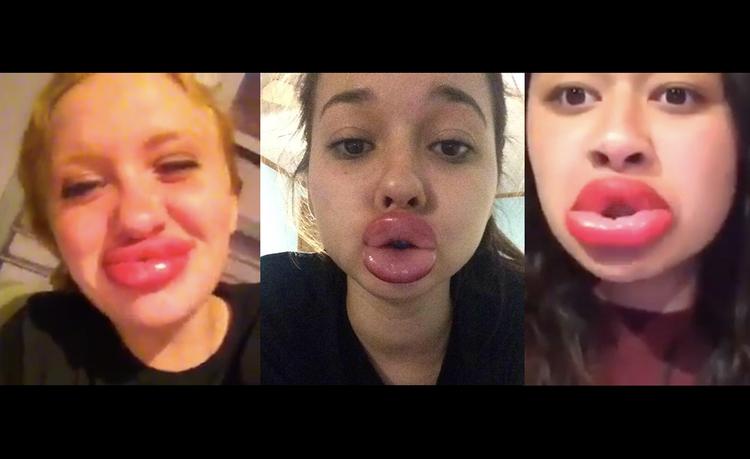 OPHÆVET. En ny trend på nettet får teenagere til at bruge flasker og shotglas til at vakuum-hæve deres læber op til overstørrelse. Læger og forældre er i oprør. (Foto: Screenshots/YouTube). 