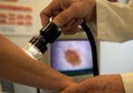 Undersøgelse. En patient undersøges for hudkræft i et modermærke. Her foregår undersøgelsen med et videodermaskop. Mænd skal være mere opmærksomme på tegn på hud- og modermærkekræft, lyder det fra flere læger. Foto: Finn Frandsen 
