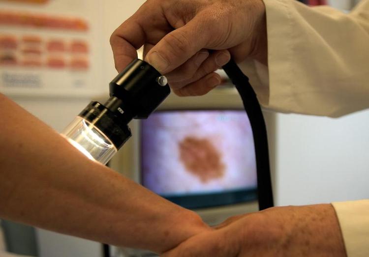 Undersøgelse. En patient undersøges for hudkræft i et modermærke. Her foregår undersøgelsen med et videodermaskop. Mænd skal være mere opmærksomme på tegn på hud- og modermærkekræft, lyder det fra flere læger. Foto: Finn Frandsen 