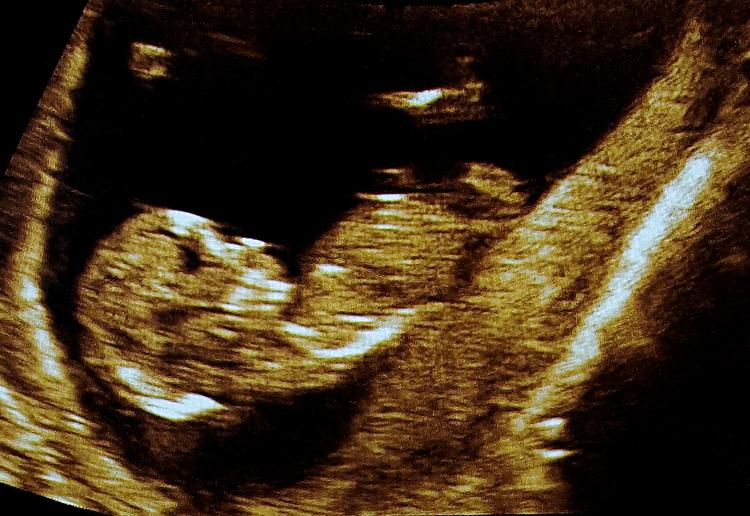Faderskabsgåde. Først blev ægtemanden dømt ude som den biologiske far til sin dreng. Så fik han comeback fordi han bærer rundt på celler fra sin ufødte tvillingebror. 