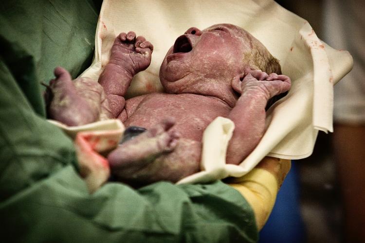 Kejsersnit. Babyer, der er forløst ved kejsersnit har en fattig bakterieflora. Hvis man smører den nyfødte ind i vaginale bakterier fra mor, får man delvist etableret en sund flora, som svarer til den man får ved en naturlig fødsel, viser ny forskning. 