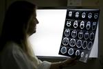 Child Neurologist Vanessa Van Der Linden observes the X-ray of a baby's skull with microcephaly at the hospital Barao de Lucena in Recife, Brazil