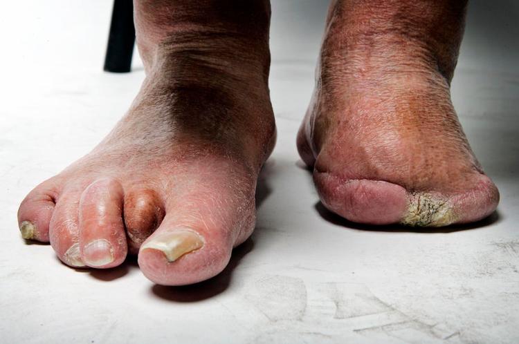 Amputation. Denne diabetespatient var i fare for at miste hele venstre fod på grund af et sår, der ikke ville vokse sammen. Det krævede otte operationer at få betændelsen ud. 