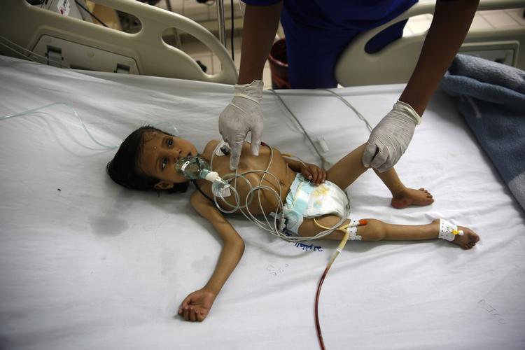 KRIGSOFFER. Underernæret dreng behandles på et sygehus i den yemenitiske hovedstad Sanaa. Konflikten i landet rammer børnene hårdt. 