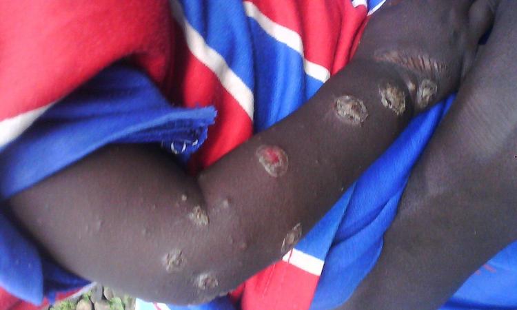 Ofre. Mindst 100 er døde efter at være blevet angrebet med et mystisk kemisk kampstof i Darfur det seneste halve år. 