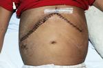 Organdonation. Gennem de seneste årtier er omkring 40 grønlandske børn døde af en medfødt, arvelig leversygdom. 16-årige Kamilla Berthelsen fik på grund af sygdommen ny lever i 2003. Hendes to ældre søskende er begge døde af sygdommen. 