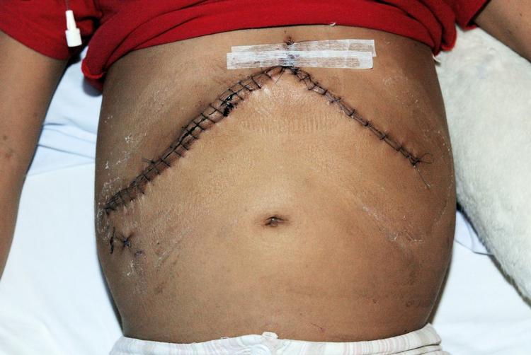 Organdonation. Gennem de seneste årtier er omkring 40 grønlandske børn døde af en medfødt, arvelig leversygdom. 16-årige Kamilla Berthelsen fik på grund af sygdommen ny lever i 2003. Hendes to ældre søskende er begge døde af sygdommen. 