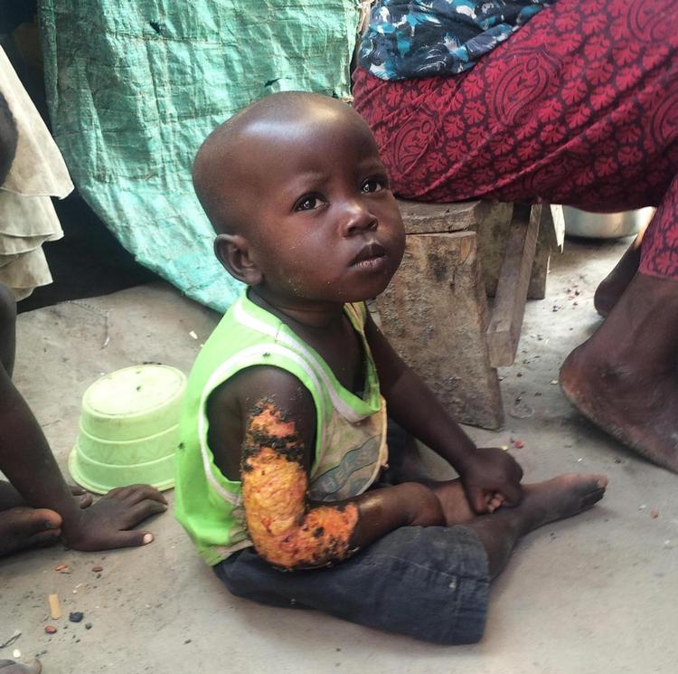 fordrevet. 100.000 er internt fordrevne i små uformelle lejre rundtomkring i landet. En af de fordrevne er denne lille dreng i lejren Carama, hvor omkring 900 bor i udkanten af Burundis hovedstad. Al mad tilberedes over åben ild i de interimistiske telte, og mange får brandsår, der ikke bliver behandlet. Der er stort set ikke kommet bistand til disse mennesker i halvandet år. Foto: Marcus Rubin 